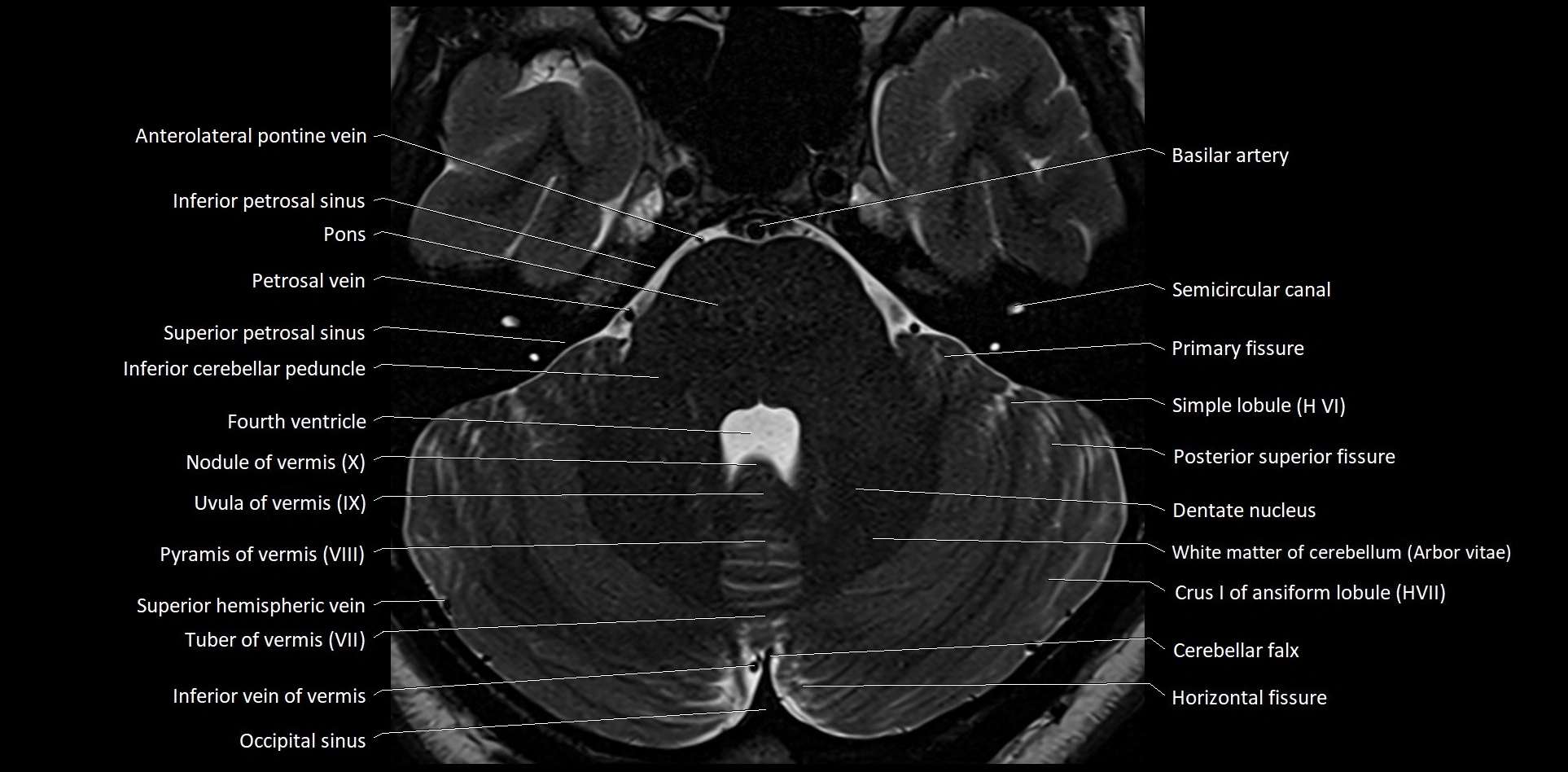 MRI Cerebellar anatomy High-resolution labelled 3T MRI image 15.webp
